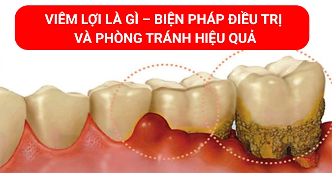 Viêm lợi là gì – Biện pháp điều trị và phòng tránh hiệu quả